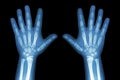 X-ray both child hands on black background