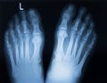 X-ray image of two feet