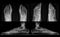 X-ray of both feet in three projections
