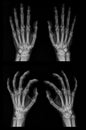 X-ray of both hands