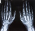 X-ray of both hands, Black background