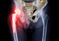 x-ray Both hip  ap view showing Right hip replacement or hip prosthesis made from titanium with fusion 3D rendering Royalty Free Stock Photo