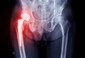 x-ray Both hip  ap view showing Right hip replacement or hip prosthesis made from titanium Royalty Free Stock Photo