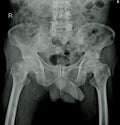 X-ray both Hip impression: Multiple bone metastasis Royalty Free Stock Photo