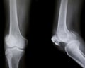 X-ray of both human knee Royalty Free Stock Photo