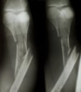 X-ray of both human legs Royalty Free Stock Photo