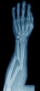 X-ray of broken arm