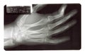 X-Ray Broken Finger Bone Royalty Free Stock Photo