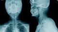 X-ray c-spine, case cervical spondylosis