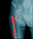 x-ray c-spine, case cervical spondylosis x-ray