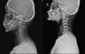 X-ray C-Spine 2 views Normal with Thoracic scoliosis with cervical spondylosis