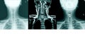 X-ray C- Spines and MRI scan of a patient with chronic upper extremities weakness showing herniated nucleus pulposus at C4-C5 Royalty Free Stock Photo
