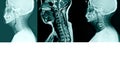 X-ray C- Spines and MRI scan of a patient with chronic upper extremities weakness showing herniated nucleus pulposus at C4-C5