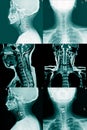 X-ray C- Spines and MRI scan of a patient with chronic upper extremities weakness showing herniated nucleus pulposus at C4-C5 Royalty Free Stock Photo