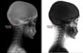 X-ray of the cervical spine. Kimerly anomaly. Cervical dysfunction. Negative. Marker.