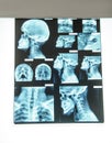 x-ray with cervical spine and paranasal sinuses