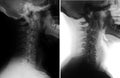 X-ray of the cervical spine. Spondylosis, osteochondrosis. Cervical dysfunction.