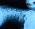 X-ray of the cervical . X ray image of the cervical spine Royalty Free Stock Photo