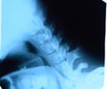 X-ray of the cervical vertebrae. X ray image of the cervical spine Royalty Free Stock Photo
