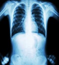 X-ray chest ( akimbo position ) ( front view ) Royalty Free Stock Photo