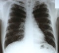 X-ray chest film