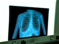 X-ray of chest heart stimulator Royalty Free Stock Photo