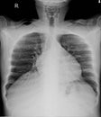 X-ray Chest LORDOTIC VIEW