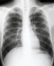 X-ray of chest of patient Royalty Free Stock Photo