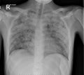 X-Ray of the chest in a patient with Active pulmonary Tuberculosis TB