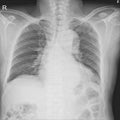 X-ray chest showing.Severe cardiomegaly. Both costophrenic angles are clear.Intact osseous structureSevere cardiomegaly.