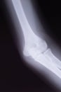 X ray, childs ulna fracture, close up