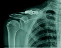 Shoulder x-ray image Royalty Free Stock Photo