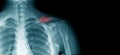 X-ray clavicle fracture