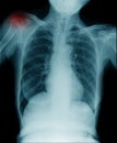 X-ray clavicle fracture