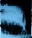 X-ray of and clavicle, X ray picture of shoulder joint