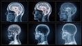 An x-ray collage displaying translucent human head profiles, highlighting the brain and skeletal structure, a visual exploration Royalty Free Stock Photo