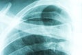 X-Ray Of Collar Bone Royalty Free Stock Photo