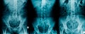 X-ray collection pelvic bone and thraco-lumbar spine