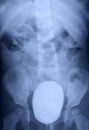 X Ray Contrast Study of Full Bladder of Child
