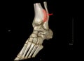 X-ray and ct scan 3d render images of the ankle reveal an abnormality of the distal tibia bone that is larger than the distal
