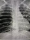 X-ray cystic lung Royalty Free Stock Photo