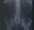 X-ray lumbar spine diagnosis