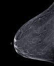 X-ray Digital Mammogram or mammography of both side breast CC view and MLO