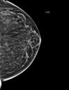 X-ray Digital Mammogram or mammography of both side breast Standard views are bilateral craniocaudal (CC