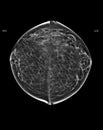 X-ray Digital Mammogram or mammography of both side breast Standard views are bilateral craniocaudal (CC