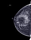 X-ray Digital Mammogram or mammography of both side breast Standard views are bilateral craniocaudal (CC