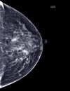 X-ray Digital Mammogram or mammography of both side breast Standard views are bilateral craniocaudal (CC