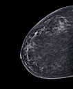 X-ray Digital Mammogram or mammography of both side breast Standard views are bilateral craniocaudal (CC