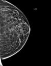 X-ray Digital Mammogram or mammography of both side breast Standard views are bilateral craniocaudal (CC