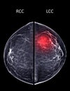 X-ray Digital Mammogram or mammography of both side breast Standard views are bilateral craniocaudal (CC